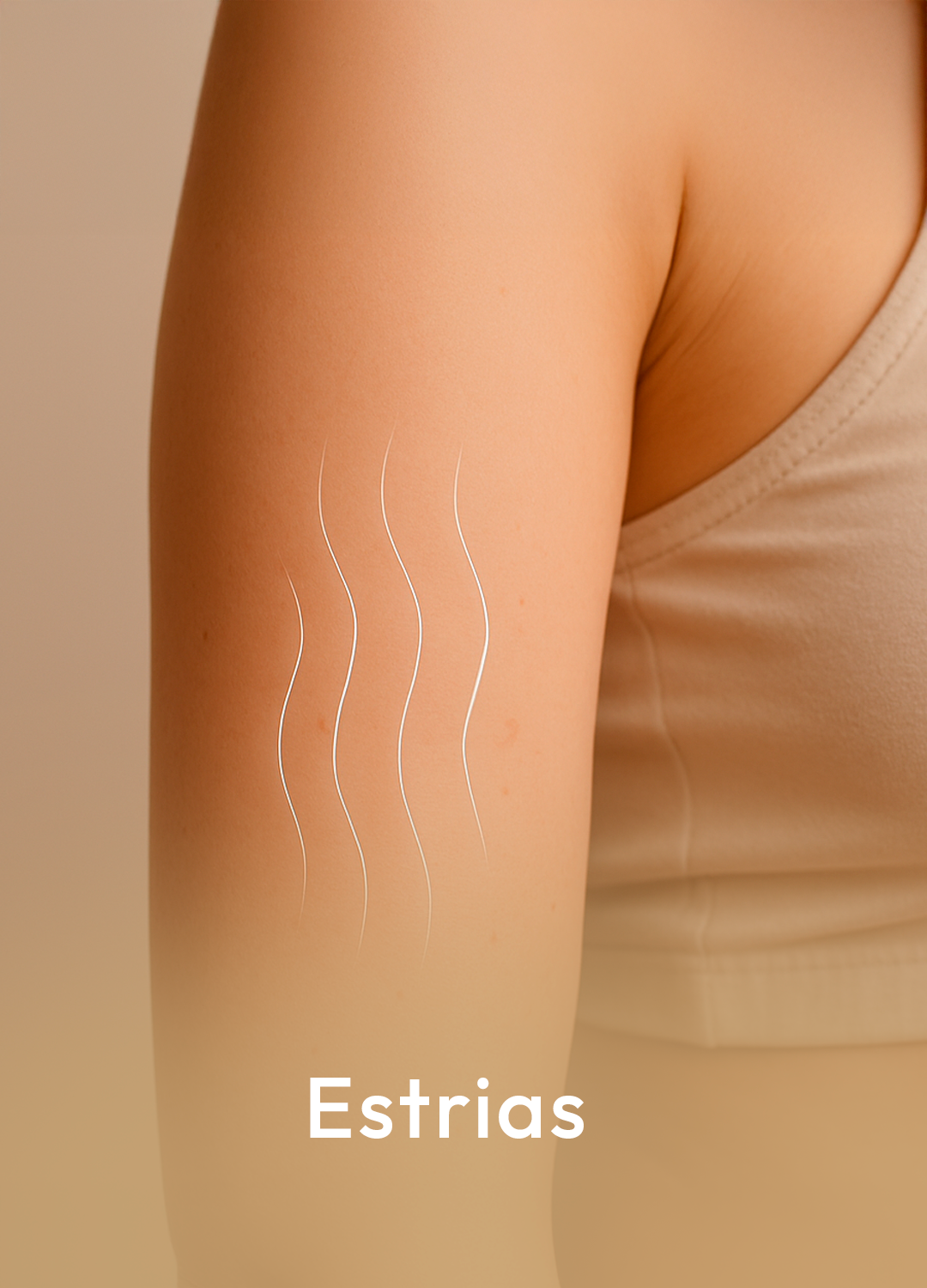 estrias